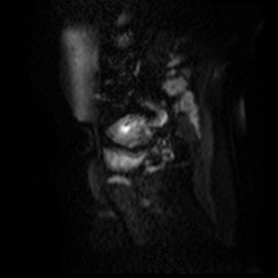 File:Bicornuate uterus (Radiopaedia 51676-57472 Sagittal DWI 9).jpg