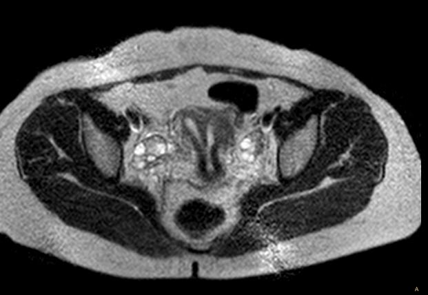 File:Bicornuate uterus with left renal agenesis (Radiopaedia 19829-19879 Axial T2 1).JPG
