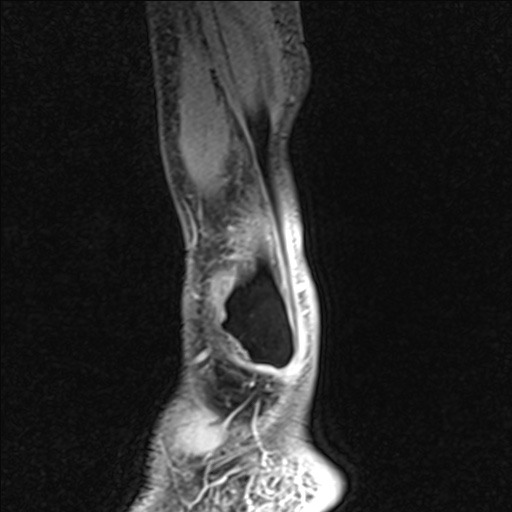 File:Bilateral Achilles tendon complete tear (Radiopaedia 81344-95051 Sagittal WE - Left 99).jpg