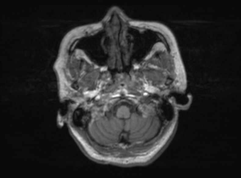 Bilateral PCA territory infarction - different ages (Radiopaedia 46200-51784 Axial T1 337).jpg