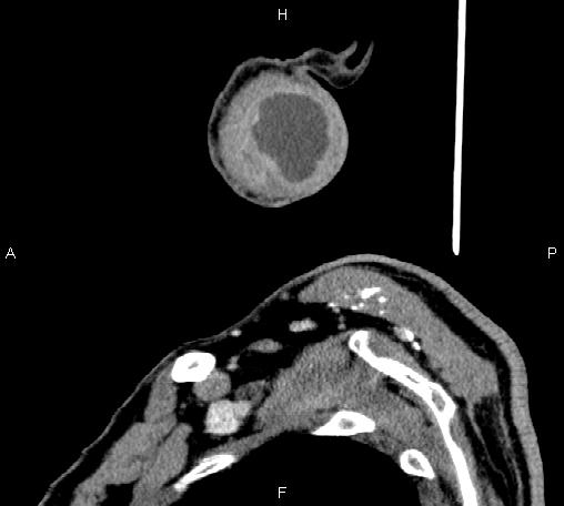 Bilateral Warthin tumors (Radiopaedia 84034-99263 D 13).jpg