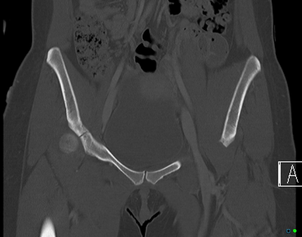 File:Bilateral acetabular fractures (Radiopaedia 79272-92308 Coronal bone window 10).jpg