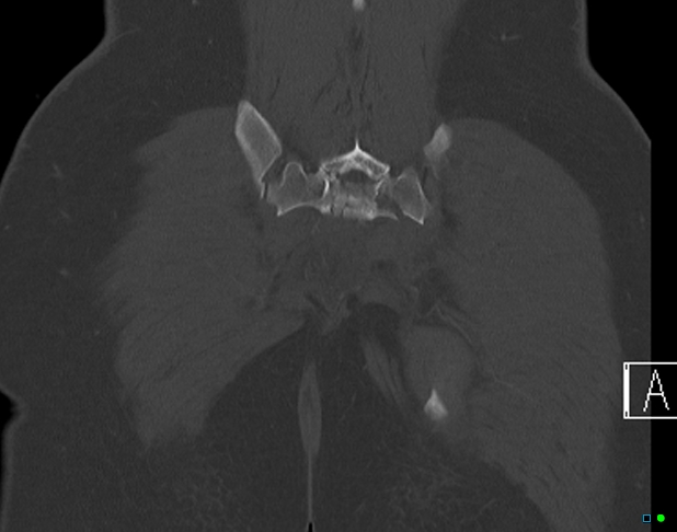 File:Bilateral acetabular fractures (Radiopaedia 79272-92308 Coronal bone window 39).jpg