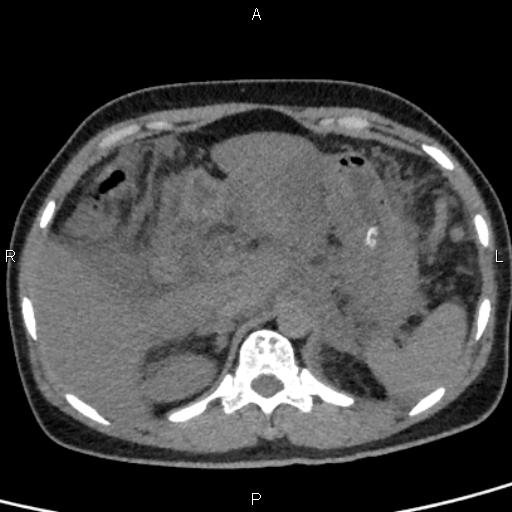Bilateral adrenal gland hyperenhancement in pancreatitis (Radiopaedia 86642-102753 Axial non-contrast 28).jpg
