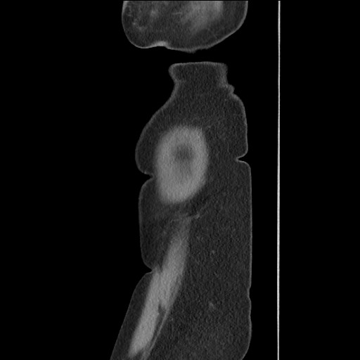 Bilateral adrenal granulocytic sarcomas (chloromas) (Radiopaedia 78375-91007 C 130).jpg