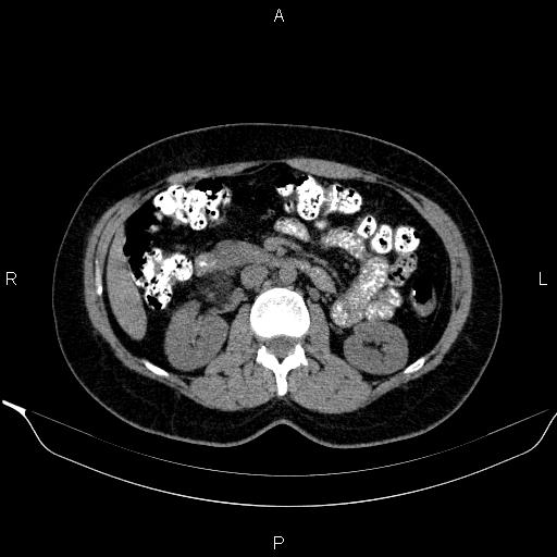 Bilateral adrenal myelolipoma (Radiopaedia 63058-71535 Axial non-contrast 74).jpg