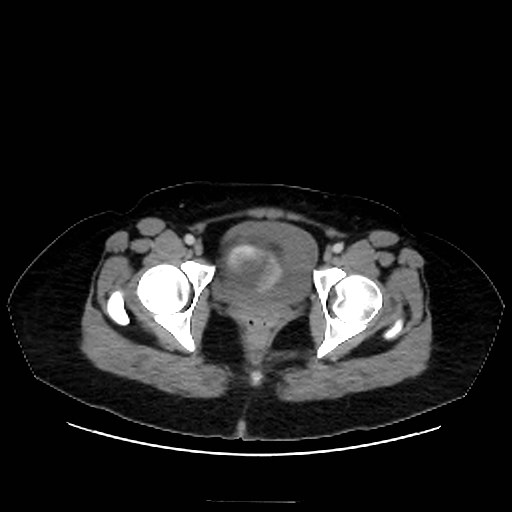 Bilateral adrenal thrombosis (Radiopaedia 58182-65256 A 75).jpg