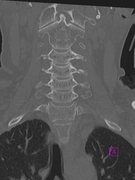 Bilateral atlanto-occipital assimilation (Radiopaedia 28350-28603 Coronal bone window 15).jpg