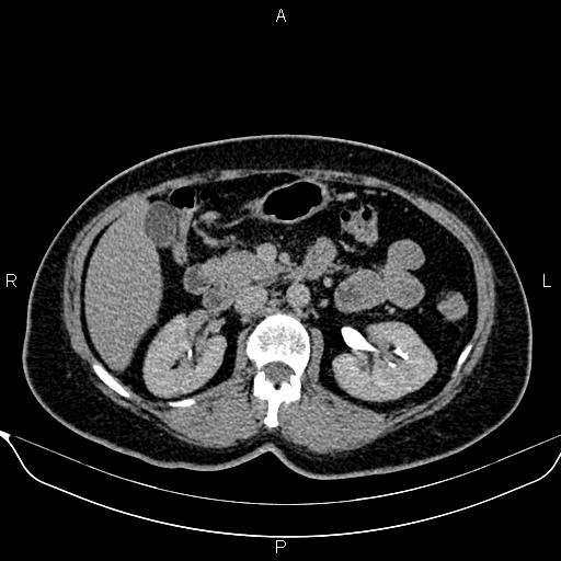 Bilateral benign adrenal adenomas (Radiopaedia 86912-103124 Axial C+ delayed 55).jpg