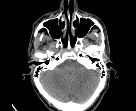 Bilateral carotid body tumors (Radiopaedia 61841-69870 Axial non-contrast 2).jpg
