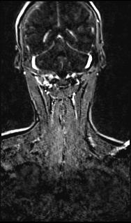 File:Bilateral carotid body tumors and right glomus jugulare tumor (Radiopaedia 20024-20060 MRA 131).jpg