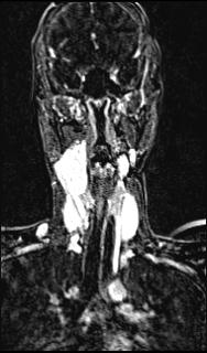 Bilateral carotid body tumors and right glomus jugulare tumor (Radiopaedia 20024-20060 MRA 93).jpg