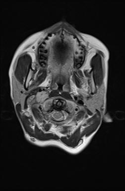 File:Bilateral carotid body tumors and right jugular paraganglioma (Radiopaedia 20024-20060 Axial 66).jpg