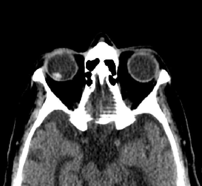 Bilateral ectopia lentis (Radiopaedia 89889-107013 Axial non-contrast 30).jpg