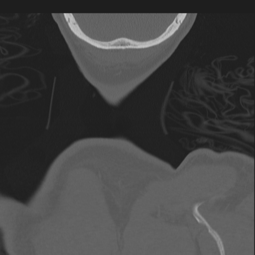 File:Bilateral locked facets (Radiopaedia 33850-35016 Coronal bone window 96).png