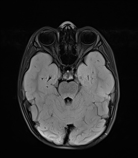 File:Bilateral mesial temporal polymicrogyria (Radiopaedia 76456-88181 Axial FLAIR 8).jpg