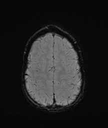 Bilateral mesial temporal polymicrogyria (Radiopaedia 76456-88181 Axial SWI 59).jpg