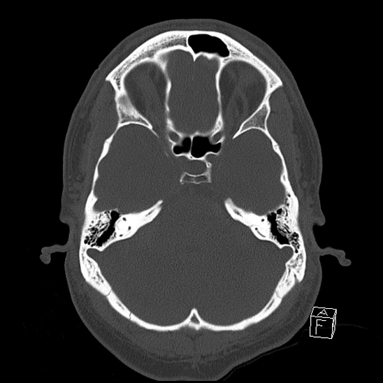Bilateral occipital condyle fracture (type 2) (Radiopaedia 87675-104089 Axial bone window 36).jpg