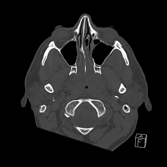 Bilateral occipital condyle fracture (type 2) (Radiopaedia 87675-104089 Axial bone window 9).jpg