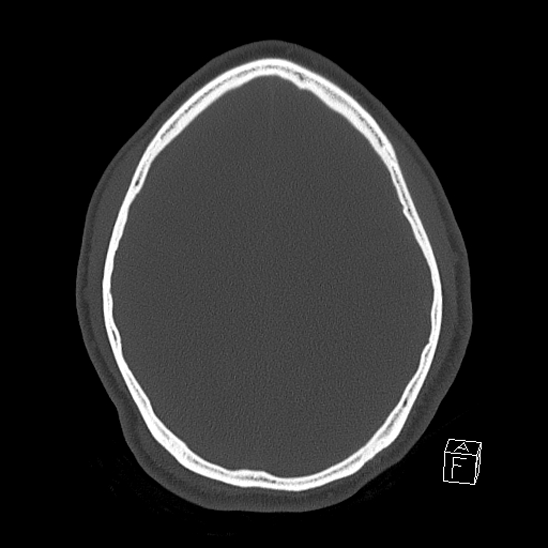 Bilateral occipital condyle fracture (type 2) (Radiopaedia 87675-104089 Axial bone window 95).jpg