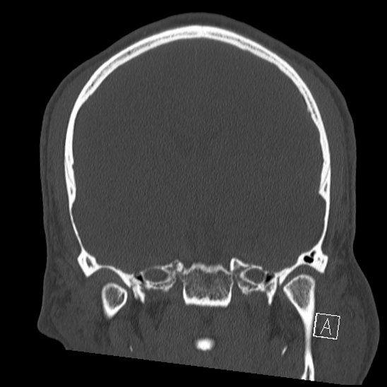 Bilateral occipital condyle fracture (type 2) (Radiopaedia 87675-104089 Coronal bone window 64).jpg