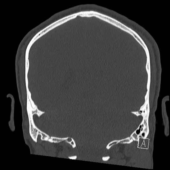 Bilateral occipital condyle fracture (type 2) (Radiopaedia 87675-104089 Coronal bone window 97).jpg