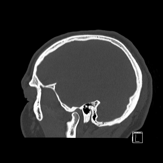Bilateral occipital condyle fracture (type 2) (Radiopaedia 87675-104089 Sagittal bone window 12).jpg