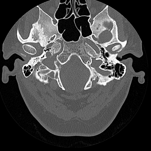 File:Bilateral ossifications of the external auditory canal (Radiopaedia 15233-15076 Axial bone window 17).jpg