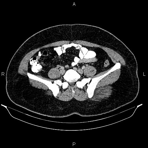 Bilateral ovarian dermoid cysts (Radiopaedia 85785-101603 A 75).jpg