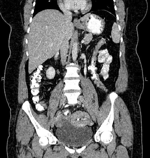 Bilateral ovarian dermoid cysts (Radiopaedia 85785-101603 C 28).jpg