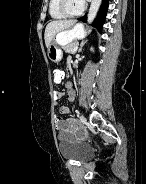 Bilateral ovarian serous cystadenocarcinoma (Radiopaedia 86062-101989 E 52).jpg