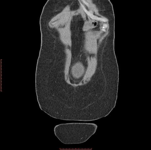 File:Bilateral ovarian serous cystadenocarcinoma with right ovarian torsion (Radiopaedia 32640-33611 B 1).jpg