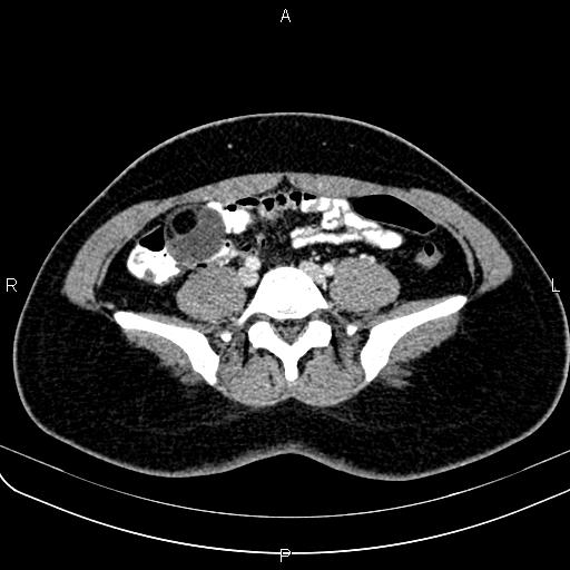 Bilateral ovarian teratoma (Radiopaedia 83131-97503 Axial With contrast 9).jpg
