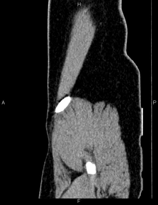 Bilateral ovarian teratoma (Radiopaedia 83131-97503 D 107).jpg