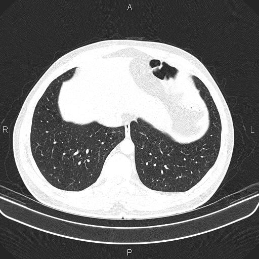 File:Bilateral pulmonary AVM (Radiopaedia 83134-97505 Axial lung window 59).jpg