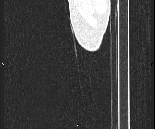 Bilateral pulmonary AVM (Radiopaedia 83134-97505 Sagittal lung window 122).jpg