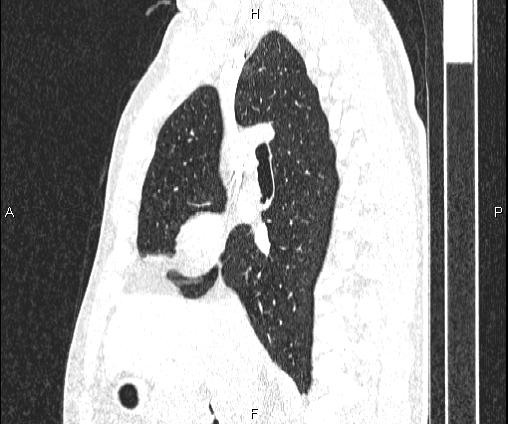 Bilateral pulmonary AVM (Radiopaedia 83134-97505 Sagittal lung window 52).jpg