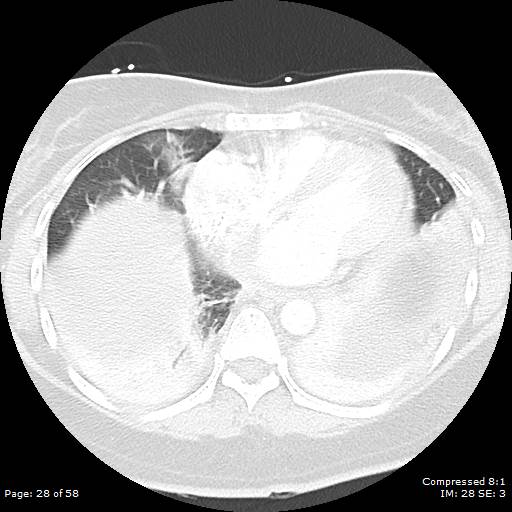 Bilateral pulmonary emboli with Hampton hump sign (Radiopaedia 54070-60246 Axial lung window 28).jpg
