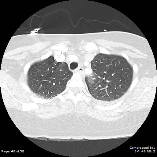 Bilateral pulmonary emboli with Hampton hump sign (Radiopaedia 54070-60246 Axial lung window 48).jpg