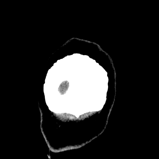 File:Bilateral subacute subdural hematoma (Radiopaedia 69240-79018 Coronal non-contrast 57).jpg