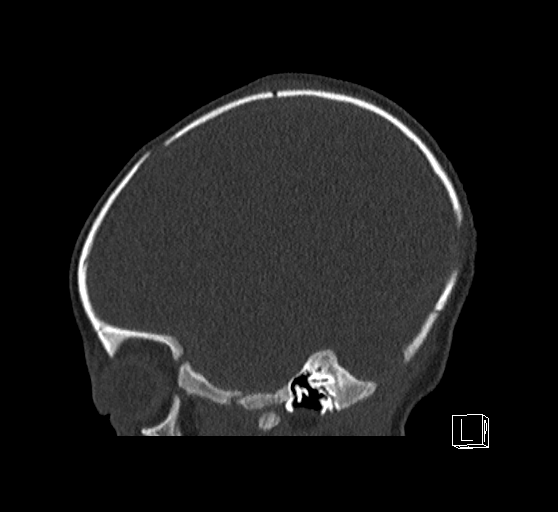 Bilateral subdural hemorrhage and parietal skull fracture (Radiopaedia 26058-26192 Sagittal bone window 75).png