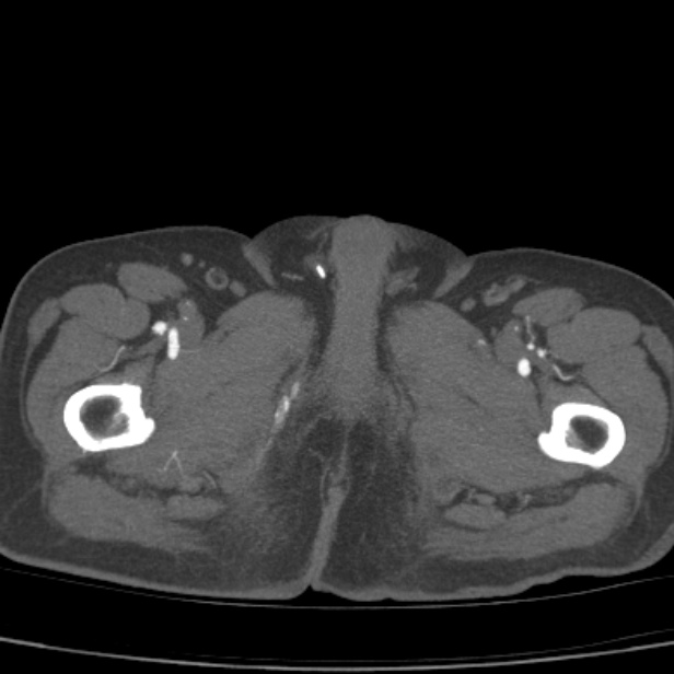 Bilateral superficial femoral arterial occlusion (Radiopaedia 25682-25857 A 31).jpg