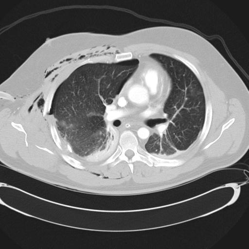 Bilateral traumatic renovascular injury (Radiopaedia 32051-32995 Axial lung window 26).jpg