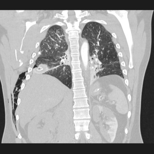 Bilateral traumatic renovascular injury (Radiopaedia 32051-32995 Coronal lung window 55).jpg