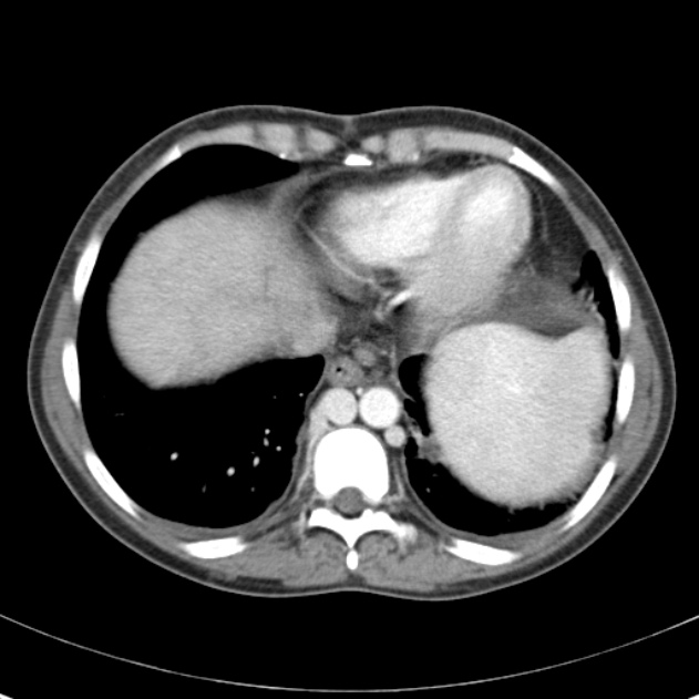 Biliary necrosis - liver transplant (Radiopaedia 21876-21846 B 6).jpg