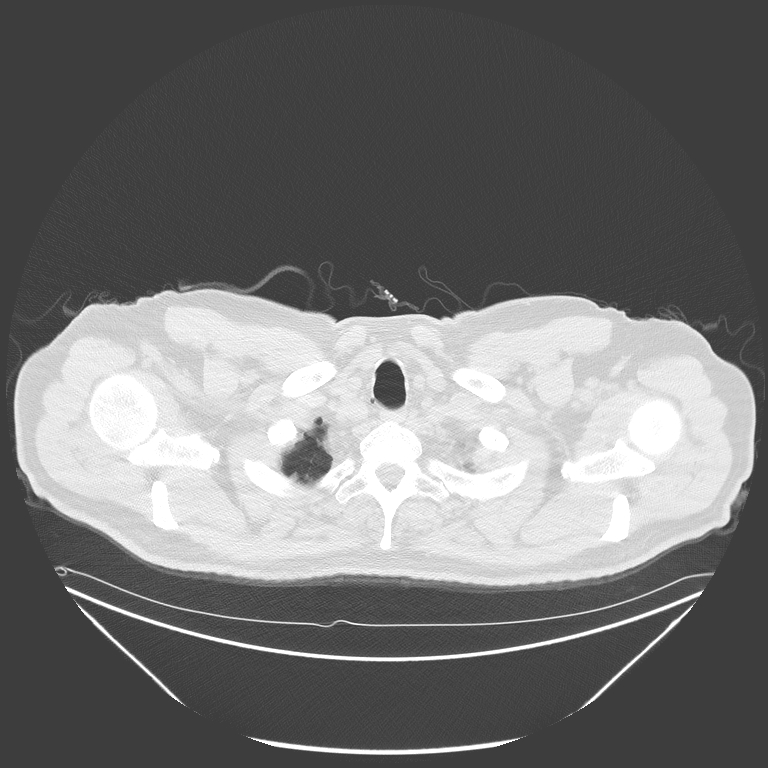 Birt-Hogg-Dubé syndrome (Radiopaedia 52578-58491 Axial lung window 2).jpg