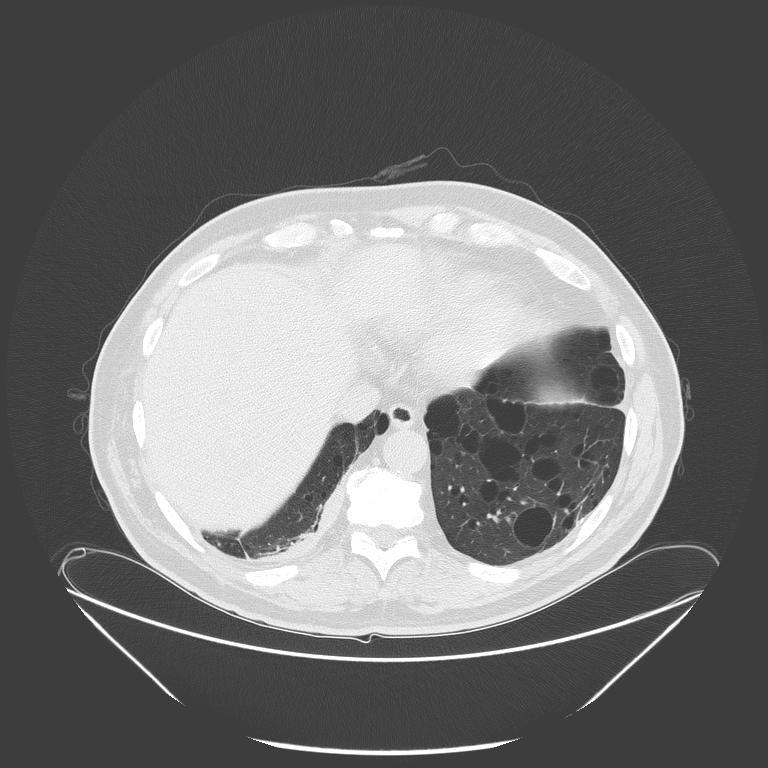 Birt-Hogg-Dubé syndrome (Radiopaedia 52578-58491 Axial lung window 51).jpg