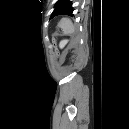 Blunt abdominal trauma with solid organ and musculoskelatal injury with active extravasation (Radiopaedia 68364-77895 C 125).jpg