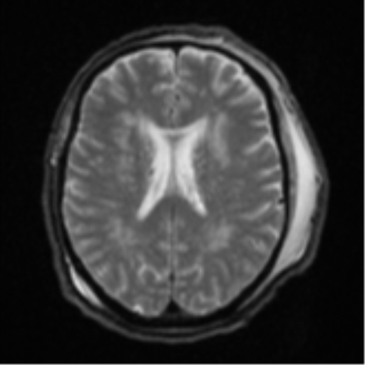 Blunt cerebrovascular injury (Radiopaedia 53682-59745 Axial DWI 19).png