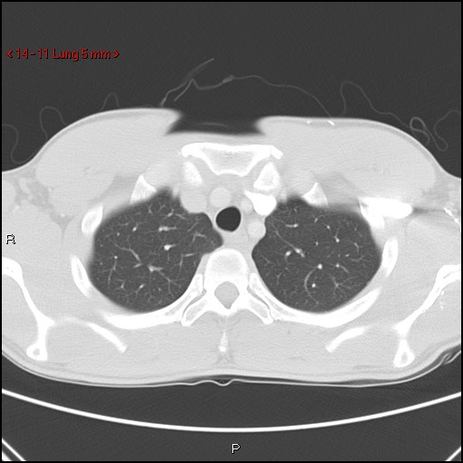 Blunt chest trauma - pulmonary interstitial emphysema and pneumomediastinum (Radiopaedia 20666-20552 Axial lung window 11).jpg